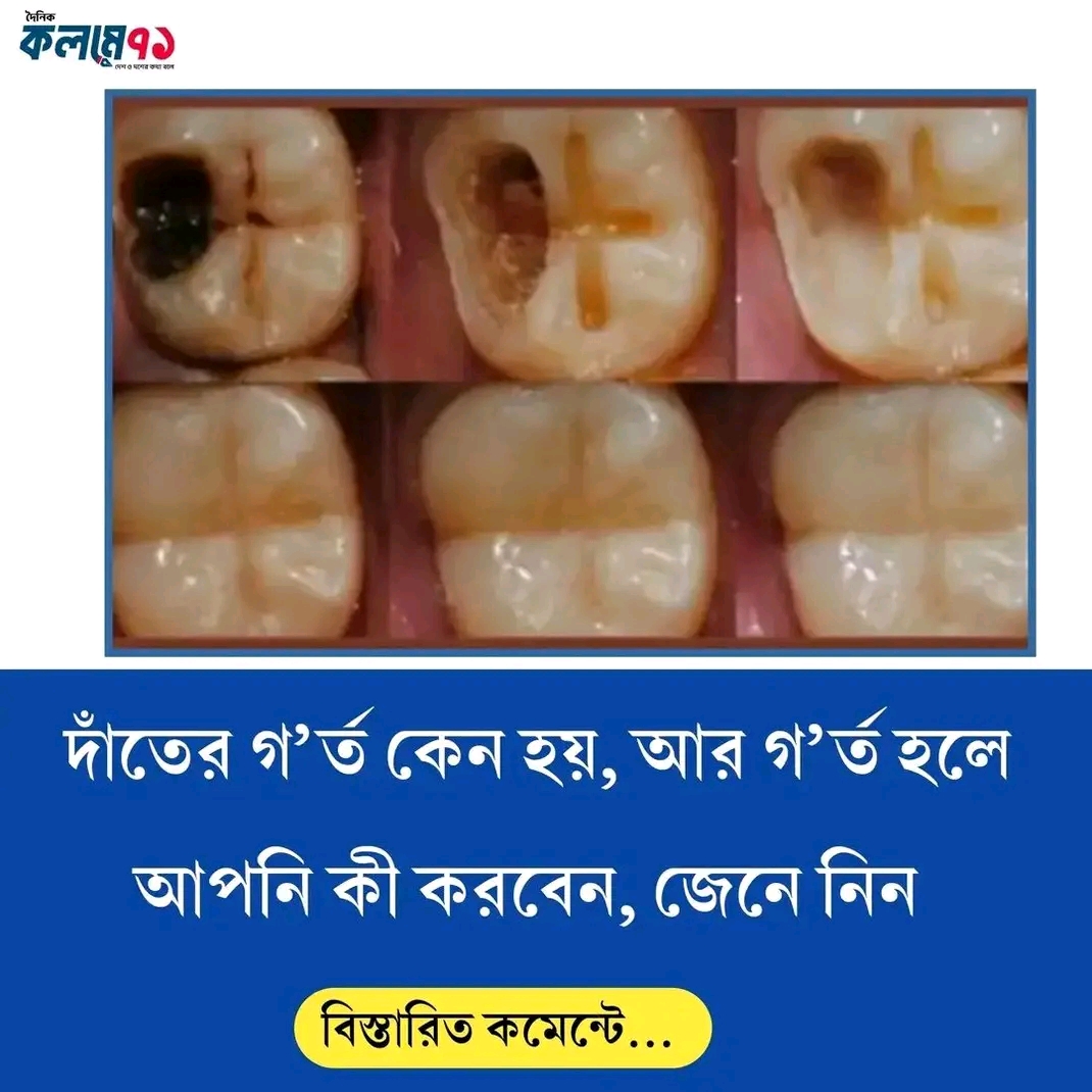 দাঁতের গ’র্ত কেন হয়, আর গ’র্ত হলে আপনি কী করবেন, জেনে নিন