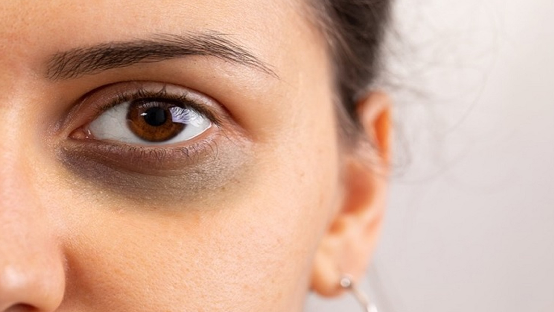 কোন ভি’টামিনের অ’ভাবে চো’খের নিচে কা’লি পড়ে, জেনে নিন প্র’তিকা’রের উপায়